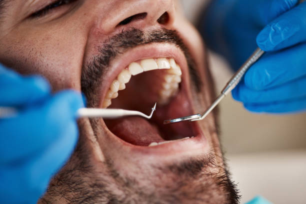 Best Chipped Tooth Repair Near Me  in Cambria, IL